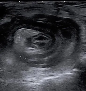 Imagen de Eco abdominal